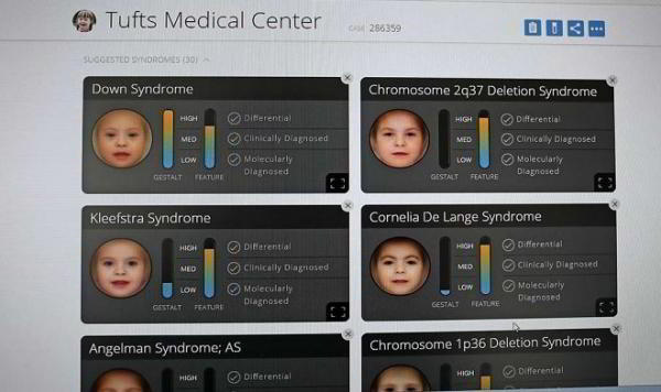 Приложение Face2Gene диагностирует редкие генетические аномалии по обычной фотографии Приложение Face2Gene диагностирует редкие генетические аномалии по обычной фотографии