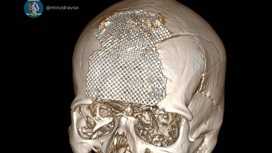 Хирурги восстановили череп ветерану СВО с помощью 3D-технологий Хирурги восстановили череп ветерану СВО с помощью 3D-технологий