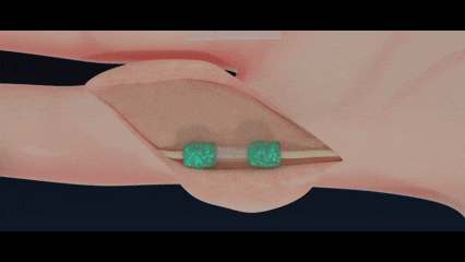 Учёные создали биосовместимый полимер, способный прочно склеивать ткани (2 фото) Учёные создали биосовместимый полимер, способный прочно склеивать ткани (2 фото)